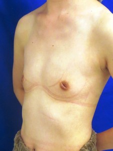 ②術前　左斜位